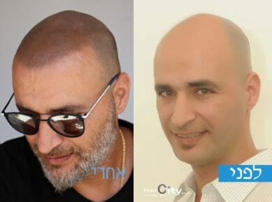 קעקוע שיער